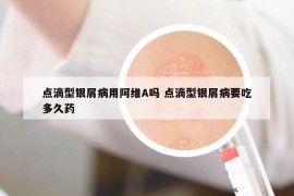 点滴型银屑病用阿维A吗 点滴型银屑病要吃多久药