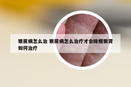 银屑病怎么治 银屑病怎么治疗才会除根银霄如何治疗