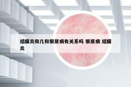 结膜炎和几和银屑病有关系吗 银屑病 结膜炎