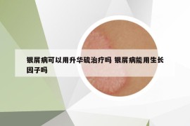 银屑病可以用升华硫治疗吗 银屑病能用生长因子吗