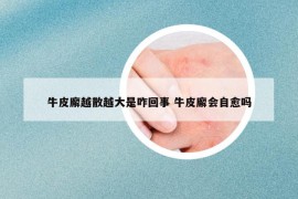 牛皮廨越散越大是咋回事 牛皮廨会自愈吗