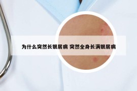 为什么突然长银屑病 突然全身长满银屑病