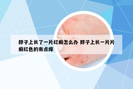 脖子上长了一片红癣怎么办 脖子上长一片片癣红色的有点痒