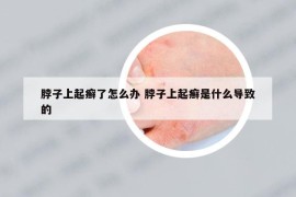 脖子上起癣了怎么办 脖子上起癣是什么导致的