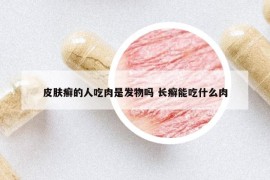 皮肤癣的人吃肉是发物吗 长癣能吃什么肉