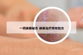 一切顽癣秘方 顽癣治疗特效验方