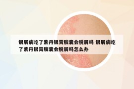 银屑病吃了紫丹银霄胶囊会脱屑吗 银屑病吃了紫丹银霄胶囊会脱屑吗怎么办