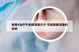 央视4治疗牛皮癣泡澡方子 牛皮肤癣泡澡的药材