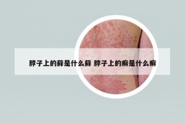 脖子上的藓是什么藓 脖子上的癣是什么癣