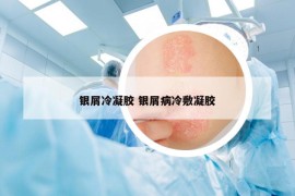 银屑冷凝胶 银屑病冷敷凝胶