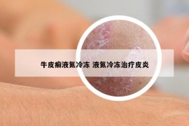 牛皮癣液氮冷冻 液氮冷冻治疗皮炎