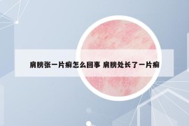 肩膀张一片癣怎么回事 肩膀处长了一片癣