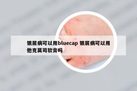 银屑病可以用bluecap 银屑病可以用他克莫司软膏吗