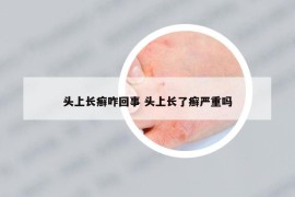 头上长癣咋回事 头上长了癣严重吗