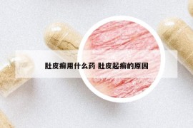 肚皮癣用什么药 肚皮起癣的原因