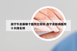 南宁牛皮癣哪个医院比较好 南宁皮肤病医院十大排名榜