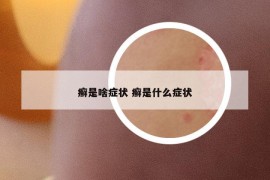 癣是啥症状 癣是什么症状