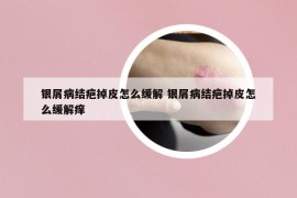 银屑病结疤掉皮怎么缓解 银屑病结疤掉皮怎么缓解痒