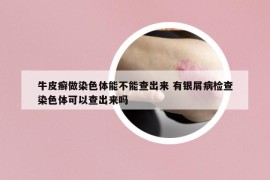 牛皮癣做染色体能不能查出来 有银屑病检查染色体可以查出来吗