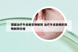 德国治疗牛皮癣生物制剂 治疗牛皮肤癣的生物制剂价格