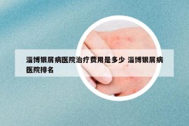 淄博银屑病医院治疗费用是多少 淄博银屑病医院排名