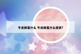 牛皮鲜是什么 牛皮鲜是什么症状?