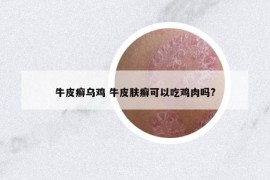 牛皮癣乌鸡 牛皮肤癣可以吃鸡肉吗?