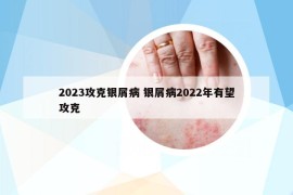 2023攻克银屑病 银屑病2022年有望攻克