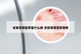 皮肤变硬超厚是什么癣 皮肤变硬变厚很痒