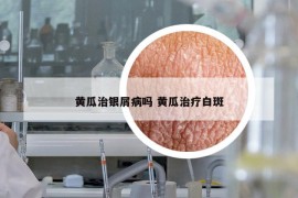 黄瓜治银屑病吗 黄瓜治疗白斑