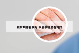 银屑病哪看的好 银屑病哪里看得好