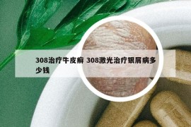 308治疗牛皮癣 308激光治疗银屑病多少钱