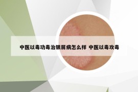 中医以毒功毒治银屑病怎么样 中医以毒攻毒