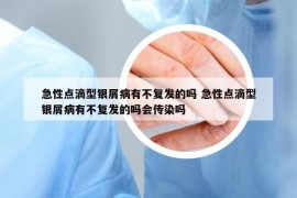 急性点滴型银屑病有不复发的吗 急性点滴型银屑病有不复发的吗会传染吗