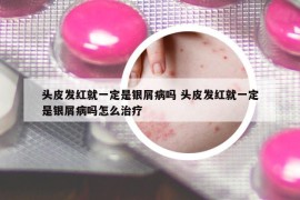 头皮发红就一定是银屑病吗 头皮发红就一定是银屑病吗怎么治疗