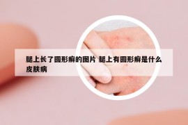 腿上长了圆形癣的图片 腿上有圆形癣是什么皮肤病