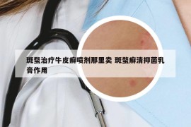 斑蝥治疗牛皮癣喷剂那里卖 斑蝥癣清抑菌乳膏作用