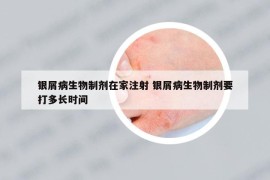 银屑病生物制剂在家注射 银屑病生物制剂要打多长时间