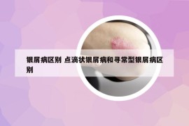 银屑病区别 点滴状银屑病和寻常型银屑病区别