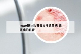 ruxolitinib乳膏治疗银屑病 银屑病的乳膏