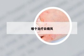 哪个治疗白癜风