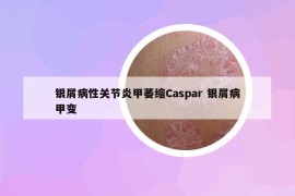 银屑病性关节炎甲萎缩Caspar 银屑病甲变