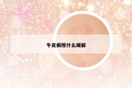 牛皮癣擦什么缓解