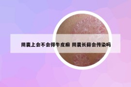 阴囊上会不会得牛皮癣 阴囊长藓会传染吗