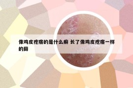 像鸡皮疙瘩的是什么癣 长了像鸡皮疙瘩一样的藓