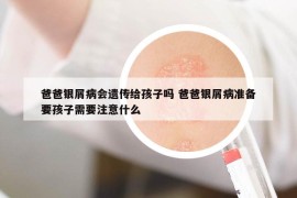 爸爸银屑病会遗传给孩子吗 爸爸银屑病准备要孩子需要注意什么