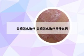 头癣怎么治疗 头癣怎么治疗用什么药