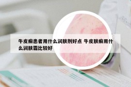 牛皮癣患者用什么润肤剂好点 牛皮肤癣用什么润肤霜比较好