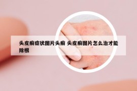 头皮癣症状图片头癣 头皮癣图片怎么治才能除根