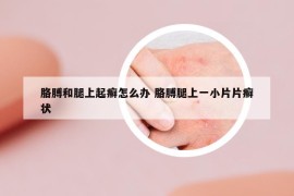 胳膊和腿上起癣怎么办 胳膊腿上一小片片癣状